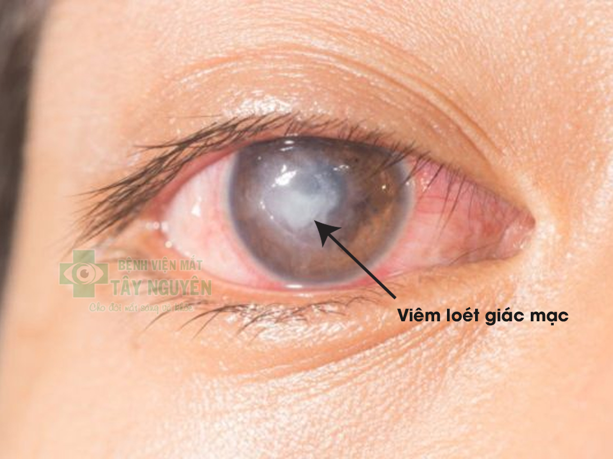 BỆNH VIÊM LOÉT GIÁC MẠC